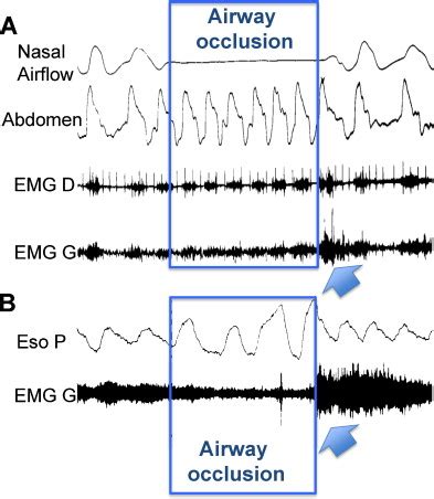 Airway Occlusion And Genioglossus Activity Obstructive Sleep Apnea Is