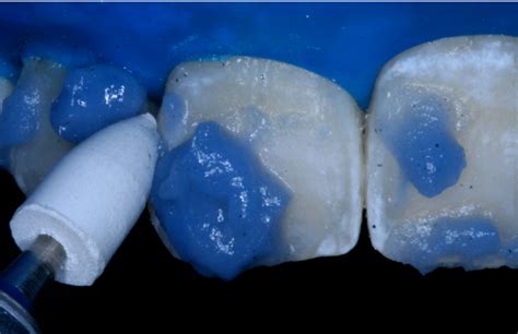 Figure From Conservative Treatment Of Enamel Hypomineralization