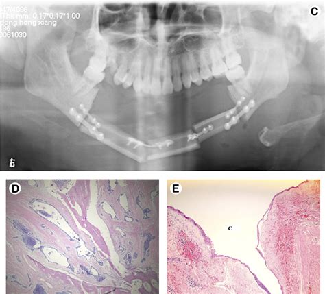 Clinical And Radiologic Features Of Desmoplastic Ameloblastoma