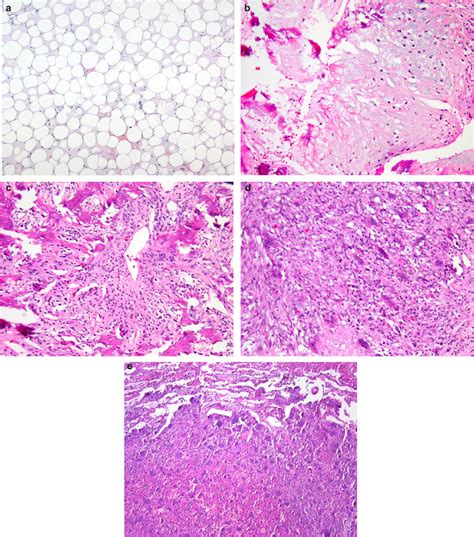 Distant Metastasis In Retroperitoneal Dedifferentiated Liposarcoma Is