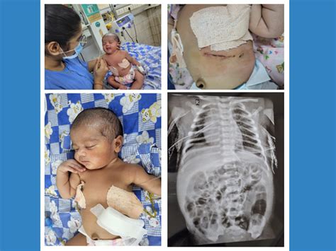 Congenital Diaphragmatic Hernia Treatment And Surgery In Faridbad