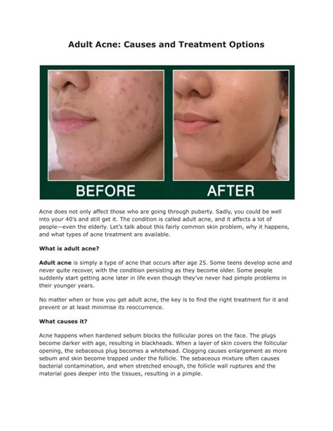 Ppt Adult Acne Causes And Treatment Options Dmkskincare Powerpoint Presentation Id 11372002