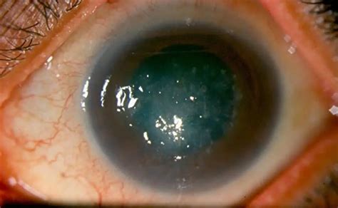 Fungal keratitis: symptoms, treatment, photo | Diseases and conditions 2025