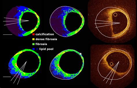 Optical Coherence Tomography For Coronary Artery Plaques A Comparison