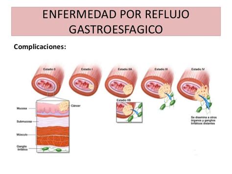 Enfermedad Por Reflujo Gastroesofagico