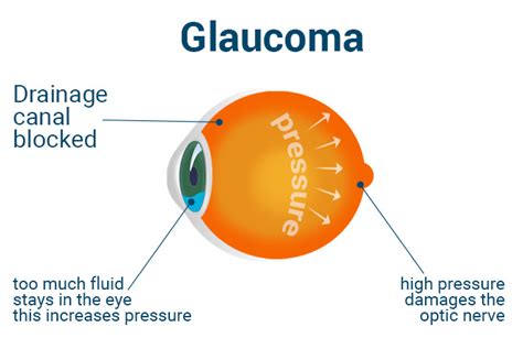 Glaucome causes symptômes et traitements Lentiamo