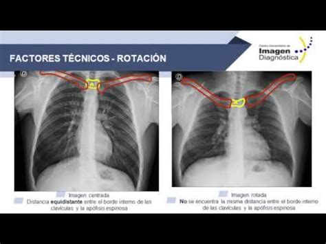 Imagenolog A De T Rax Anatom A Y Aspectos T Cnicos Youtube