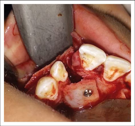 Figure From Alveolar Cleft Reconstruction Using Double Iliac