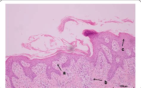 Haematoxylin And Eosin Staining Of The Skin Biopsy Finding From The