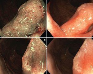 La Coloproctectomie Totale Une Procedure Medicale Quel Impact