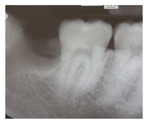 Preoperative Periapical X Ray Of The Lower Right Second Molar