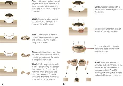 Understanding Mohs Micrographic Surgery Mayo Clinic Proceedings