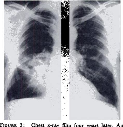 Figure 3 From Phantom Lung Tumor And Bronchogenic Carcinoma In The Same