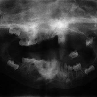 Panoramic Radiograph Revealing Multilocular Radiolucency In Left