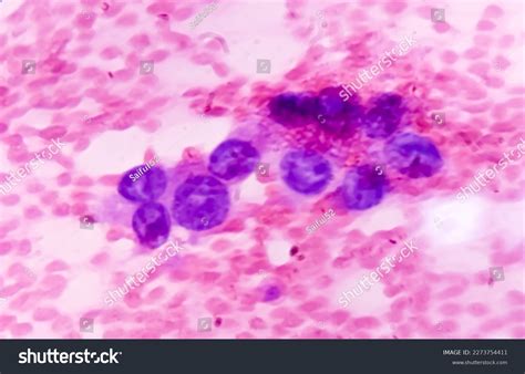 Photomicrograph Fine Needle Aspiration Fna Cytology Stock Photo