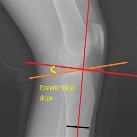 A Plain X Ray Of Lateral View Of The Right Knee Depicting The