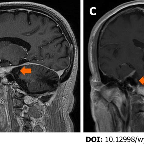 Magnetic Resonance Imaging At Last Follow Up A C Brain Magnetic