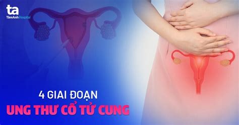 4 giai đoạn ung thư cổ tử cung chị em cần hiểu thật chi tiết