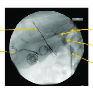 Intraoperative Cholangiogram During Lc Showing Normal Biliary Anatomy