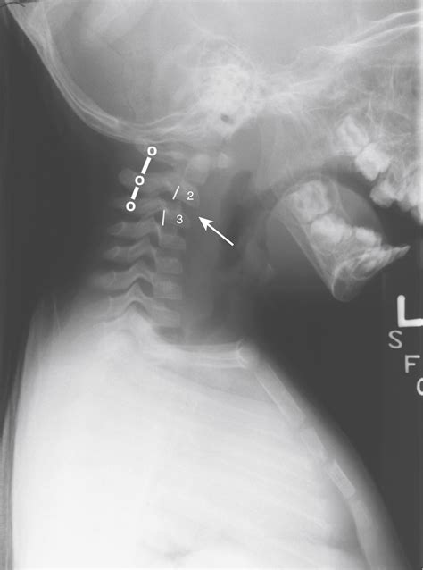 Spinal Injuries - Clinical Tree
