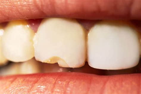 Do You Have A Broken Or Chipped Tooth The Good Dentist