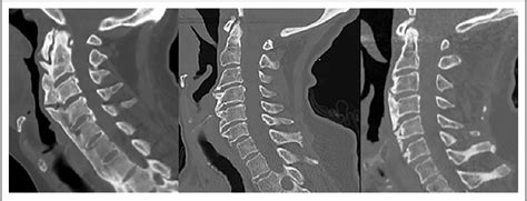 Figure From Combined Anterior Osteophytectomy And Cricopharyngeal