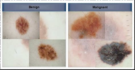 Selected skin lesion samples showing benign class (left), and the ...