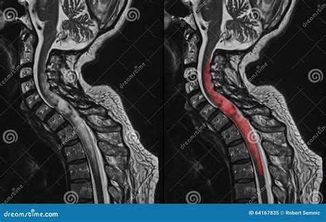 Spinal cord tumor, MRI stock image. Image of care, cord - 64167835