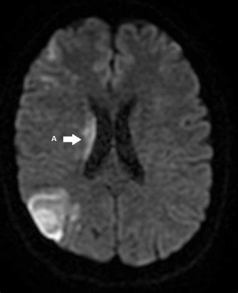 Malignant Ischemic Stroke Revealing A Spontaneous Carotid Dissection In