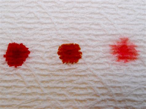 Bleeding During Pregnancy A Comprehensive Guide 1