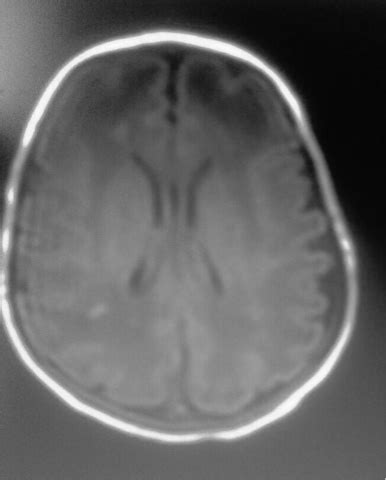 Hypoxic Ischemic Encephalopathy: MRI - Sumer's Radiology Blog