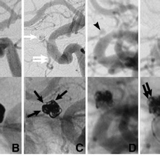 coil embolization surveillance angiography  transition  coil