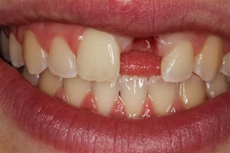 Zirconia Bridge To Replace A Missing Front Tooth