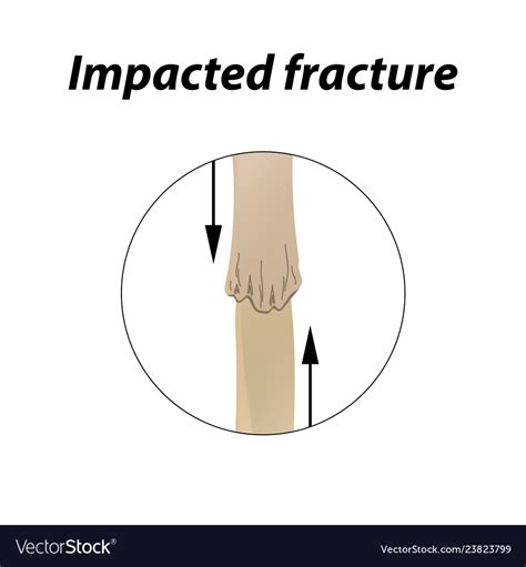 Impacted fracture bone infographics Royalty Free Vector