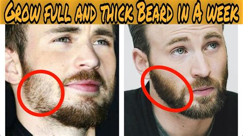 Fix Patchy Beard How To Grow A Beard Fatser Youtube