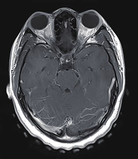 Contrast-enhanced axial T1 image showing bilateral optic neuritis ...