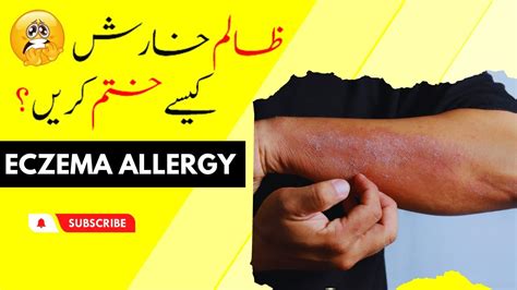 Kharish Khatam Karne Ka Asan Tarika Eczema Allergy Ka Ilaj In Urdu