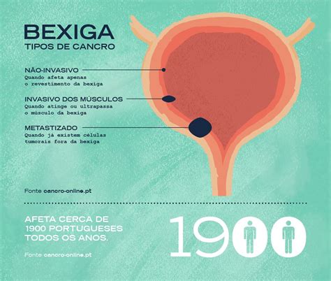 Sintomas De Problemas Na Bexiga - Sintomas De Bexiga Perfurada - RETOEDU