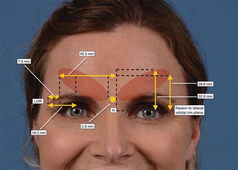 Management Of Migraine Headaches Onabotulinumtoxina Injection Intechopen