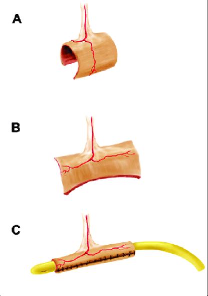 Classical Monti Procedure Download Scientific Diagram