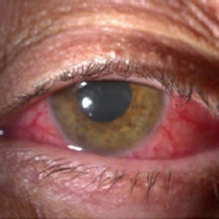 A Slit Lamp Photograph Showing Anterior Segment Reaction B