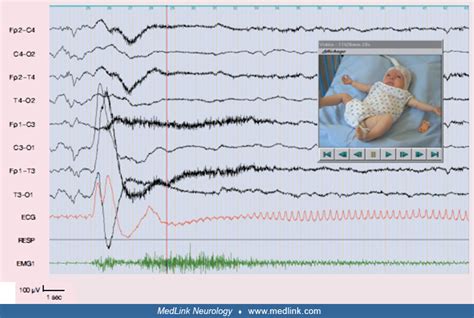 Generalized Onset Tonic Seizures Medlink Neurology