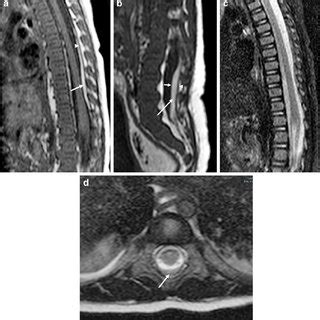 Abusive Head Trauma In A Month Old Boy A Sagittal T W Mri Of The