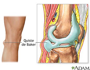 Quiste de Baker Dr Homero Pérez García