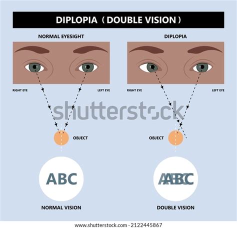 232 Diplopia Images, Stock Photos & Vectors | Shutterstock