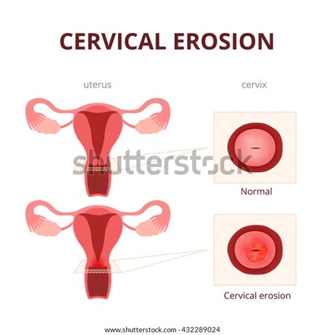 Cervical Erosion Schematic Illustration Uterus Cervix เวกเตอร์สต็อก