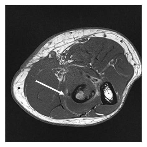 Axial T1 A B And T2 Fat Saturated Images C From Patient 1 A