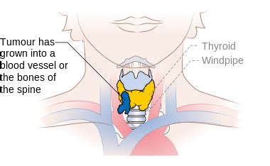 Papillary thyroid cancer staging - wikidoc