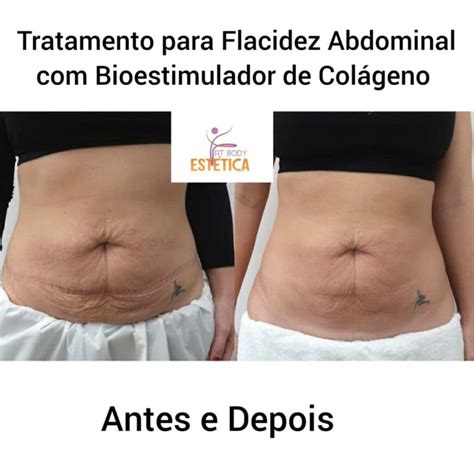 Bioestimulador De Colágeno Glúteo Antes E Depois