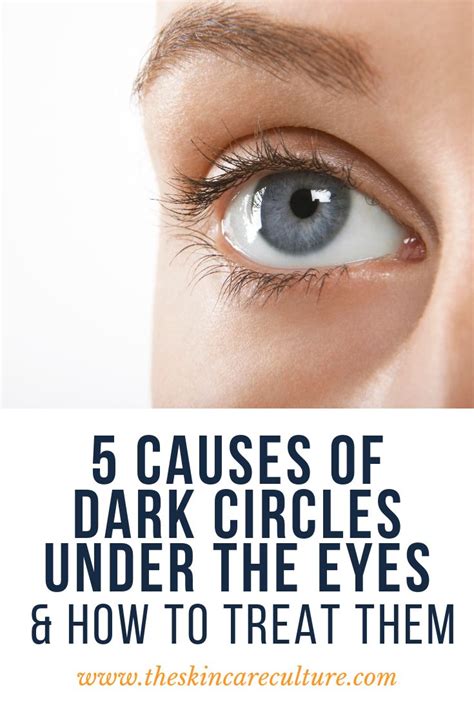 How To Get Rid Of Dark Circles Under The Eyes Dark Rings Under Eyes